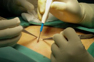 Chirurgie pariétale pour traiter une hernie ombilicale