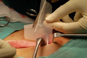 Le service de chirurgie pariétale de la Clinique Saint-Luc à Bouge (Namur) prend en charge les opérations de la hernie inguinale