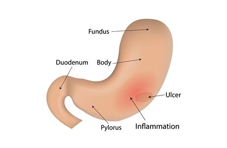 Traitement de la maladie de Crohn