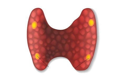 Chirurgie des glandes parathyroïdiennes