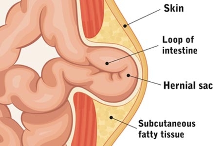 Hernies ombilicale, épigastrique et éventration