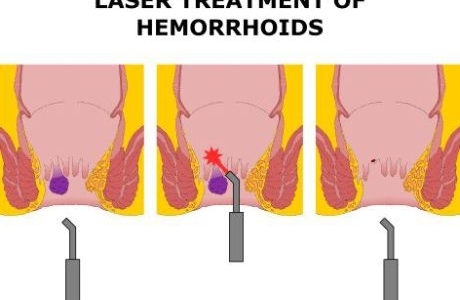 Traitement des hémorroïdes, fistules anales et kystes pilonidaux par laser : une solution non invasive proposée en Belgique