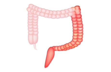 Traitement de la rectocolite ulcérohémoragique (RCUH)