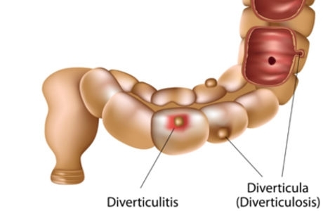 Qu’est-ce que la diverticulite ? Définition et symptômes