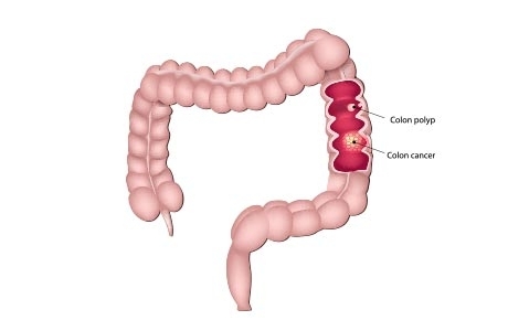 Soins contre le cancer colorectal (Côlon)