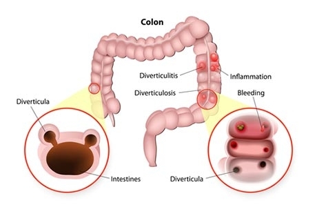 Traitement pour soigner la diverticulite
